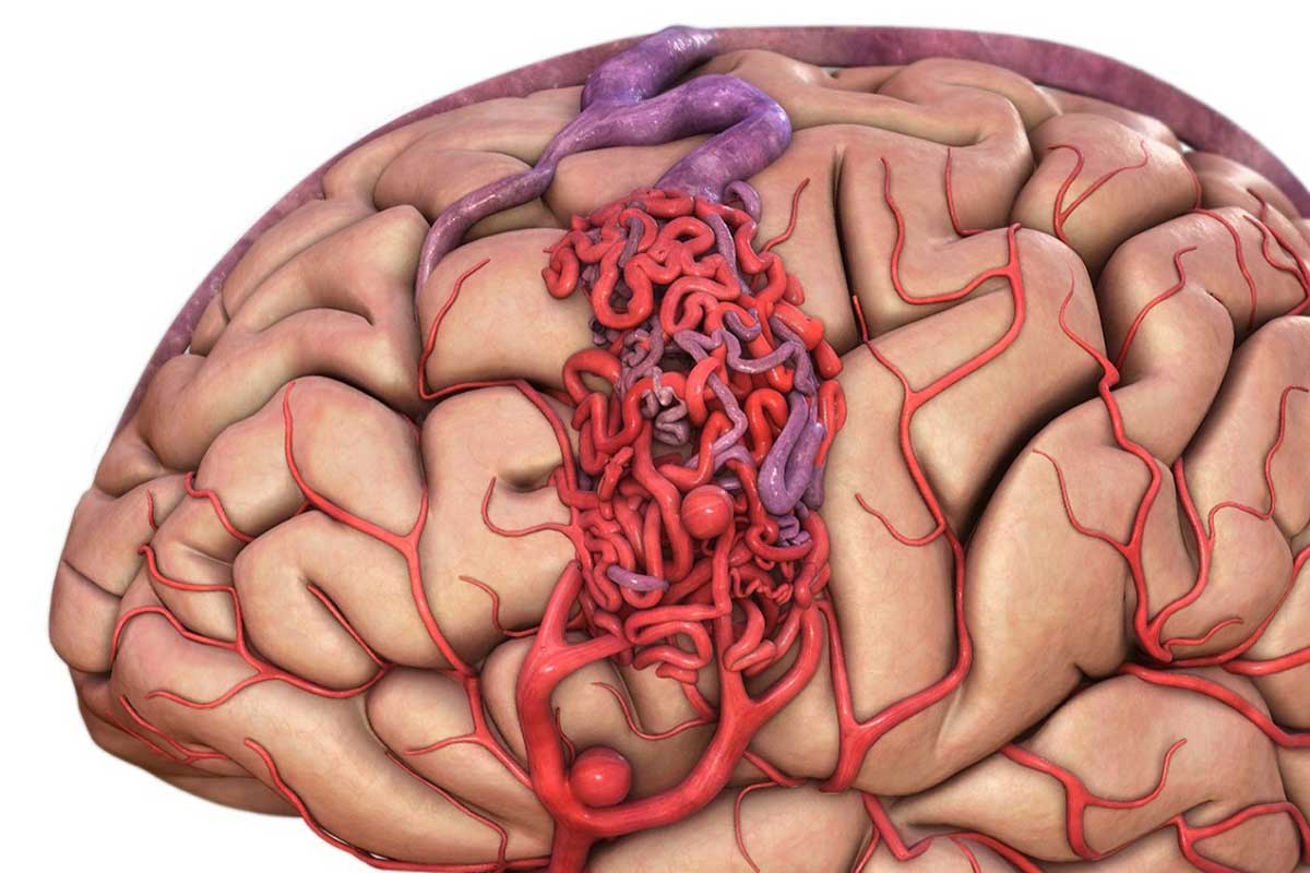 لخته خون در مغز که باعث سکته مغزی می شود