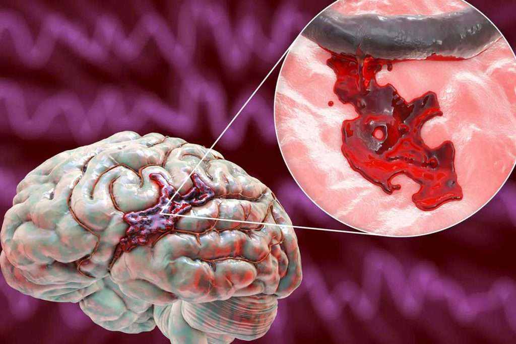 لخته خون در مغز که نشان دهنده سکته مغزی است